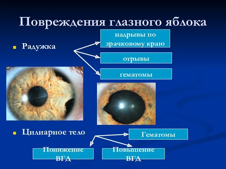 Повреждения глазного яблока Радужка Цилиарное тело надрывы по зрачковому краю