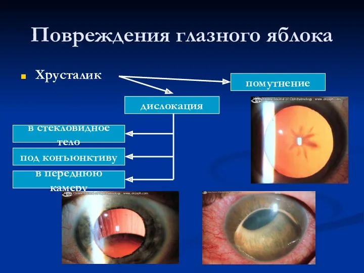 Повреждения глазного яблока Хрусталик дислокация помутнение под конъюнктиву в стекловидное тело в переднюю камеру