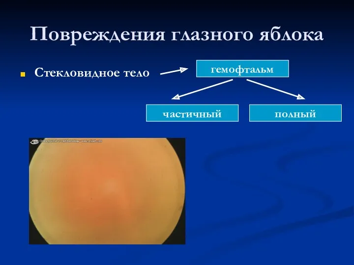 Повреждения глазного яблока Стекловидное тело частичный полный гемофтальм