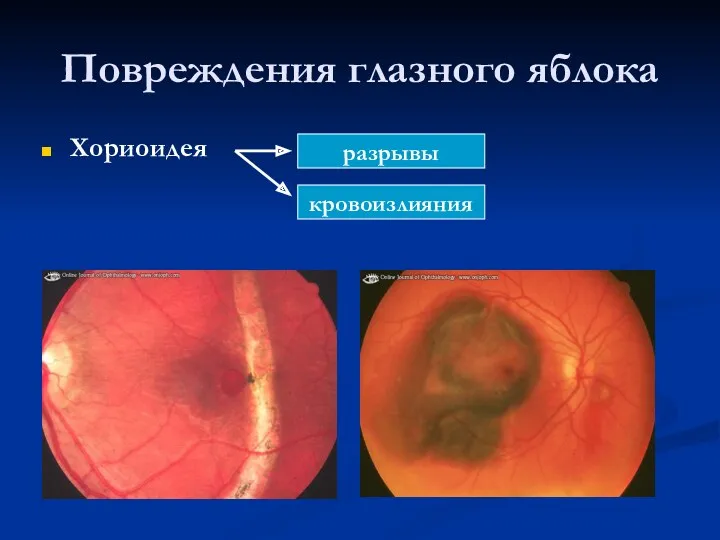 Повреждения глазного яблока Хориоидея разрывы кровоизлияния