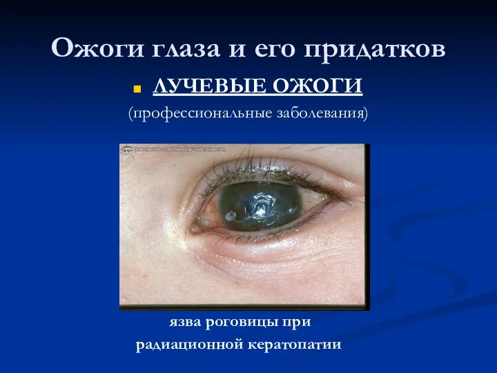 Ожоги глаза и его придатков ЛУЧЕВЫЕ ОЖОГИ (профессиональные заболевания) язва роговицы при радиационной кератопатии