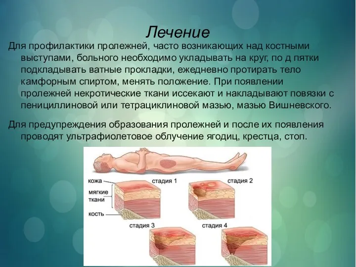 Лечение Для профилактики пролежней, часто возникающих над костными выступами, больного