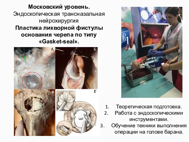 Московский уровень. Эндоскопическая трансназальная нейрохирургия Пластика ликворной фистулы основания черепа