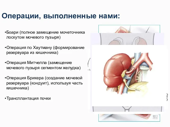 Операции, выполненные нами: Боари (полное замещение мочеточника лоскутом мочевого пузыря)