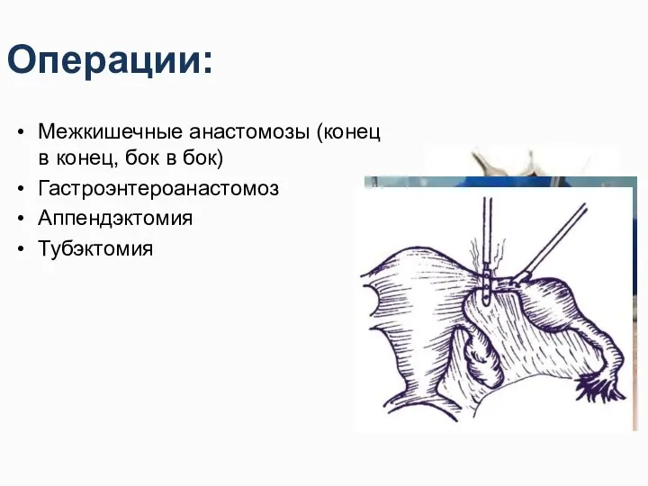 Операции: Межкишечные анастомозы (конец в конец, бок в бок) Гастроэнтероанастомоз Аппендэктомия Тубэктомия