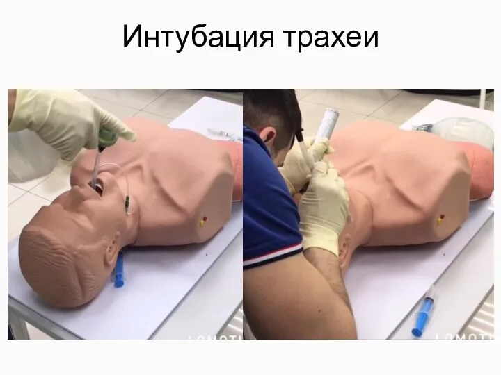 Интубация трахеи