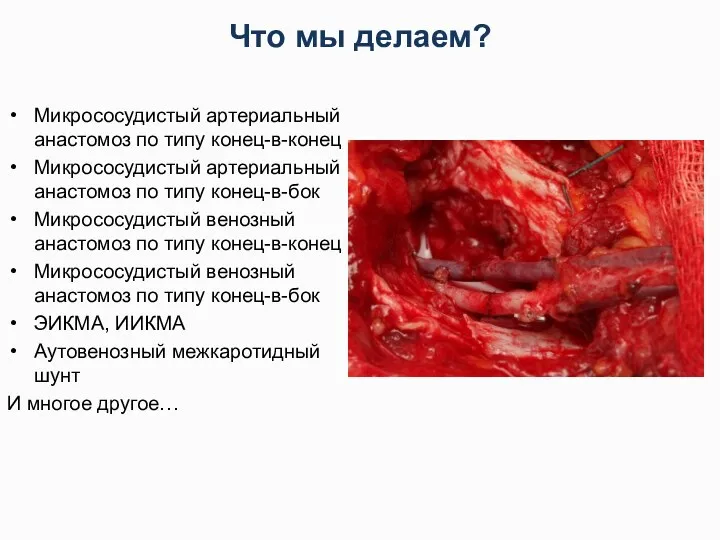 Что мы делаем? Микрососудистый артериальный анастомоз по типу конец-в-конец Микрососудистый