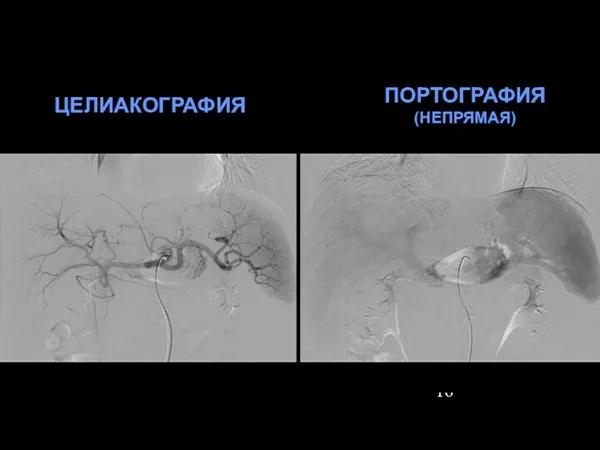 ЦЕЛИАКОГРАФИЯ ПОРТОГРАФИЯ (НЕПРЯМАЯ)