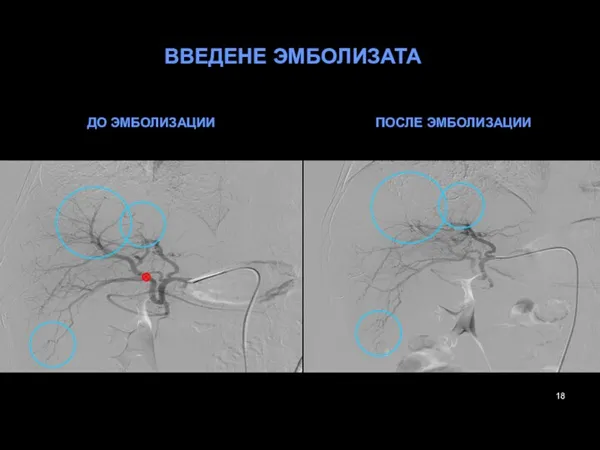 ВВЕДЕНЕ ЭМБОЛИЗАТА ДО ЭМБОЛИЗАЦИИ ПОСЛЕ ЭМБОЛИЗАЦИИ