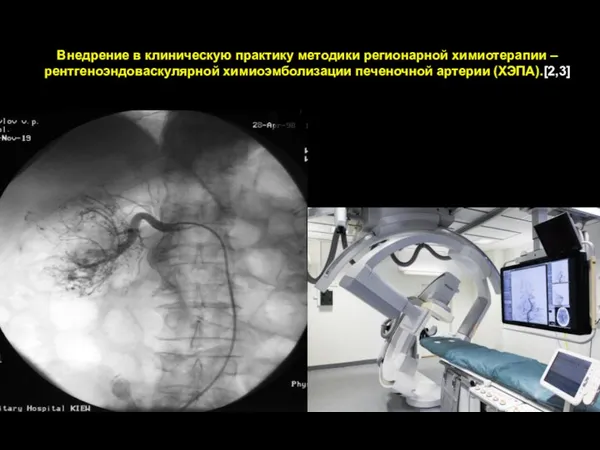 Внедрение в клиническую практику методики регионарной химиотерапии – рентгеноэндоваскулярной химиоэмболизации печеночной артерии (ХЭПА).[2,3]