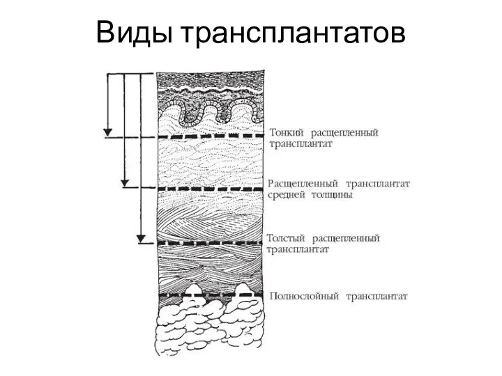 Виды трансплантатов