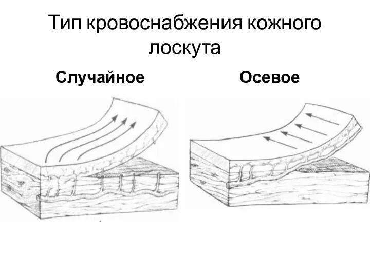 Тип кровоснабжения кожного лоскута Случайное Осевое