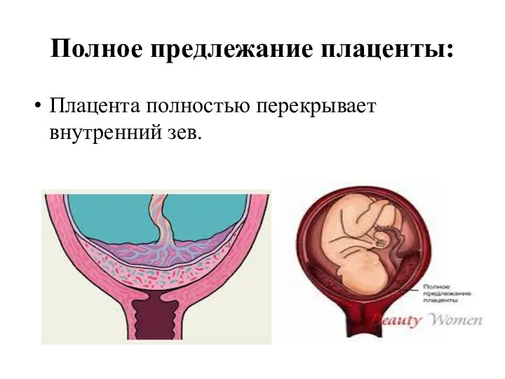 Полное предлежание плаценты: Плацента полностью перекрывает внутренний зев.