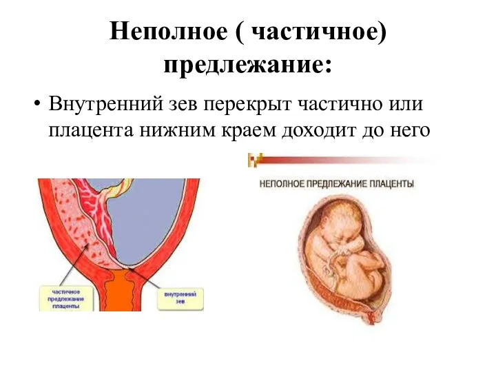Неполное ( частичное) предлежание: Внутренний зев перекрыт частично или плацента нижним краем доходит до него
