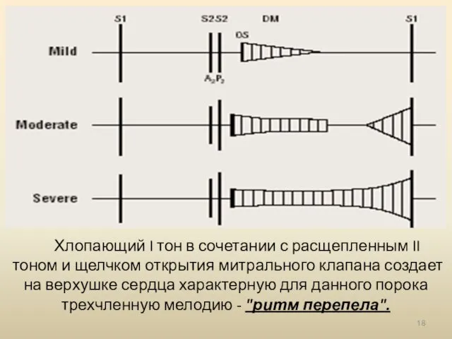 Хлопающий I тон в сочетании с расщепленным II тоном и