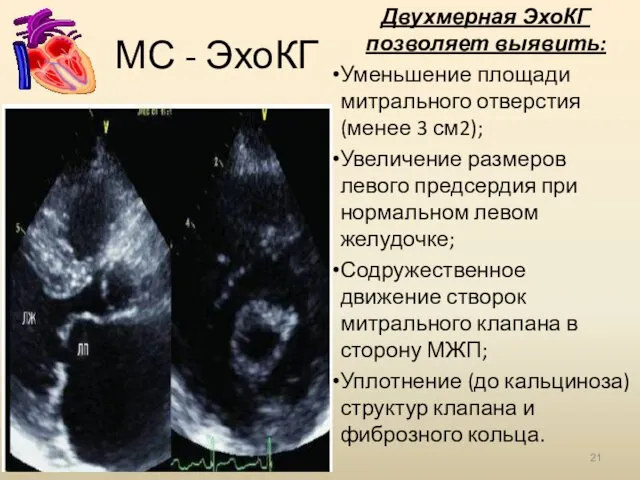 МС - ЭхоКГ Двухмерная ЭхоКГ позволяет выявить: Уменьшение площади митрального