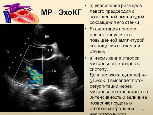 МР - ЭхоКГ а) увеличение размеров левого предсердия с повышенной