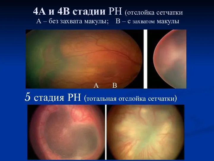 4А и 4В стадии РН (отслойка сетчатки А – без