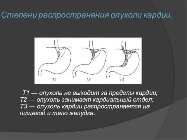 Степени распространения опухоли кардии. Т1 — опухоль не выходит за