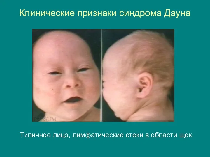 Клинические признаки синдрома Дауна Типичное лицо, лимфатические отеки в области щек