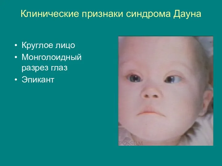 Клинические признаки синдрома Дауна Круглое лицо Монголоидный разрез глаз Эпикант