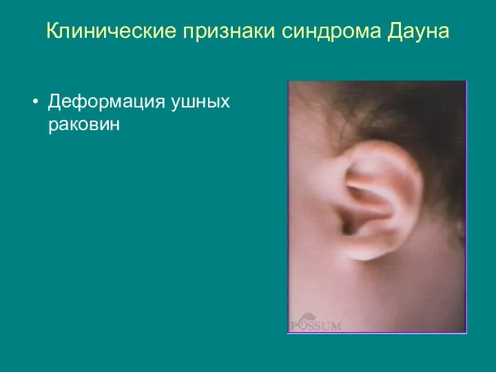 Клинические признаки синдрома Дауна Деформация ушных раковин