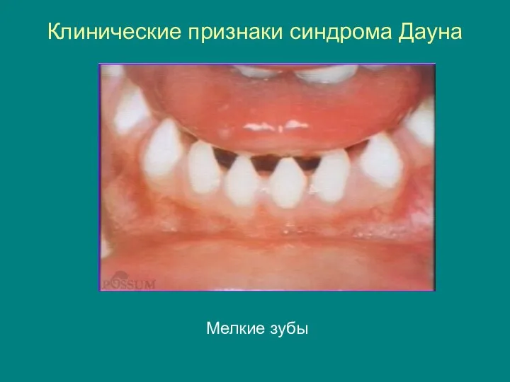 Клинические признаки синдрома Дауна Мелкие зубы