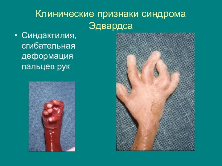 Клинические признаки синдрома Эдвардса Синдактилия, сгибательная деформация пальцев рук