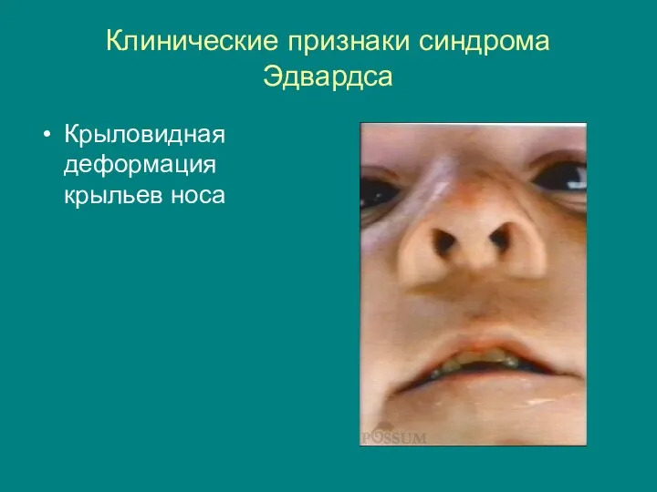 Клинические признаки синдрома Эдвардса Крыловидная деформация крыльев носа