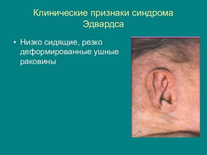 Клинические признаки синдрома Эдвардса Низко сидящие, резко деформированные ушные раковины