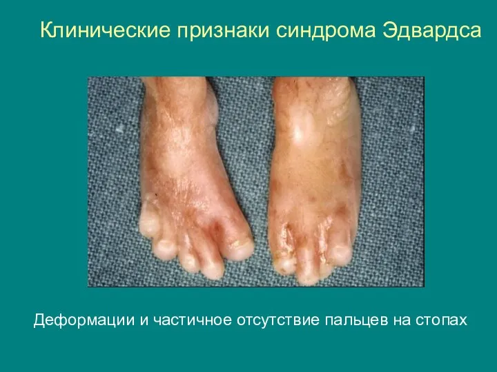 Клинические признаки синдрома Эдвардса Деформации и частичное отсутствие пальцев на стопах
