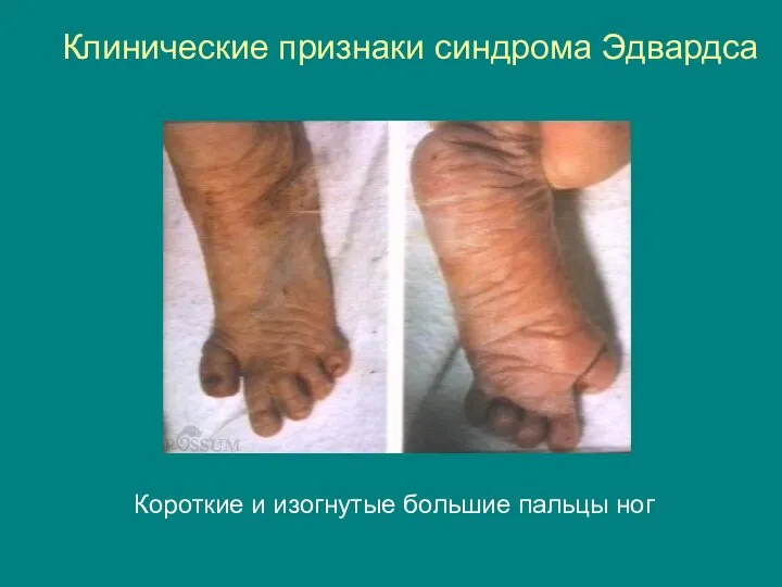 Клинические признаки синдрома Эдвардса Короткие и изогнутые большие пальцы ног