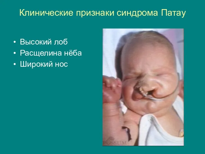 Клинические признаки синдрома Патау Высокий лоб Расщелина нёба Широкий нос