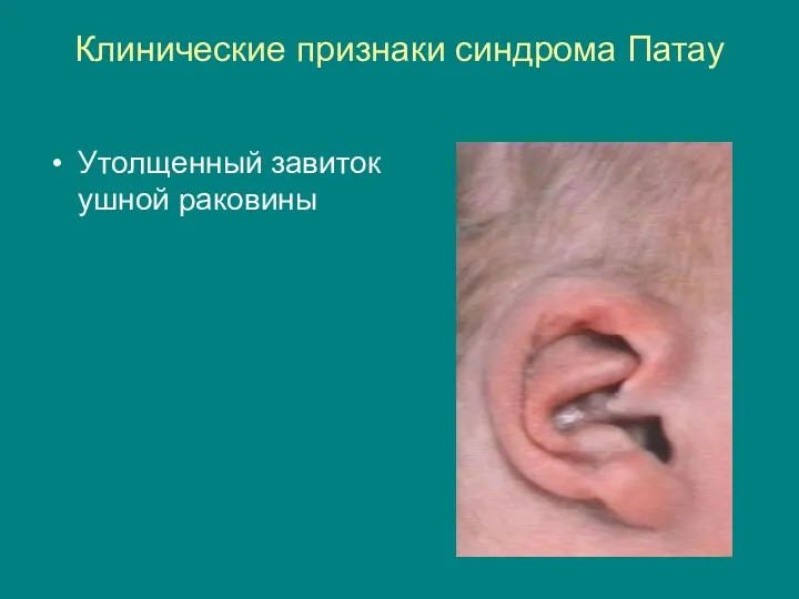 Клинические признаки синдрома Патау Утолщенный завиток ушной раковины