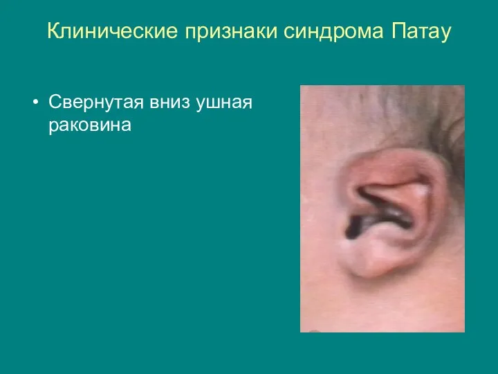 Клинические признаки синдрома Патау Свернутая вниз ушная раковина