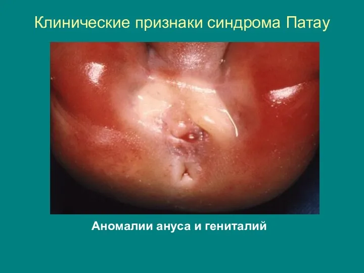 Клинические признаки синдрома Патау Аномалии ануса и гениталий