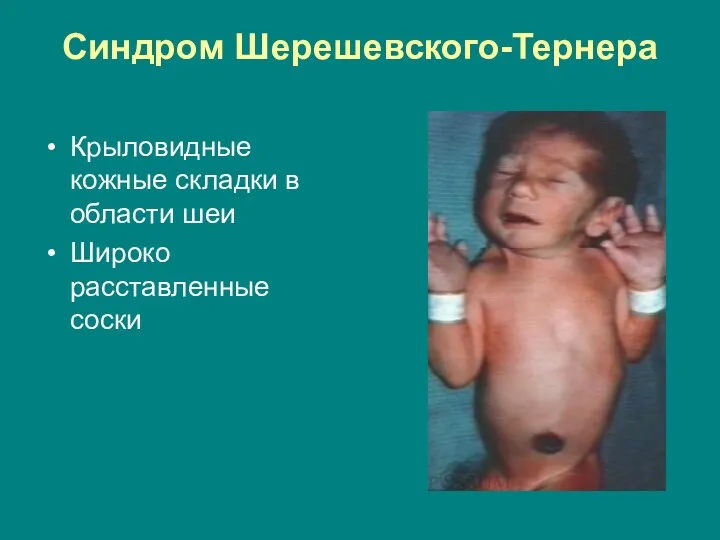 Синдром Шерешевского-Тернера Крыловидные кожные складки в области шеи Широко расставленные соски
