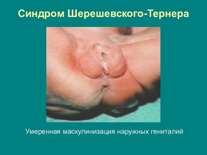 Синдром Шерешевского-Тернера Умеренная маскулинизация наружных гениталий