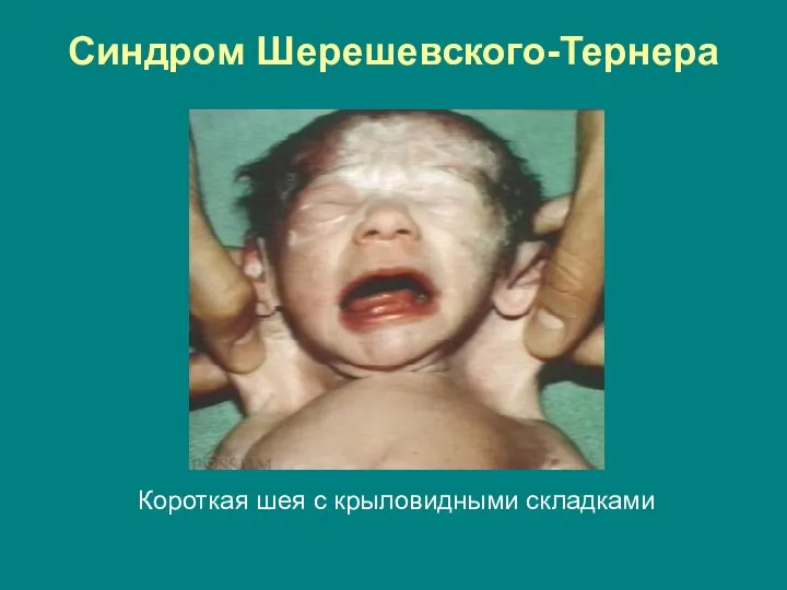 Синдром Шерешевского-Тернера Короткая шея с крыловидными складками