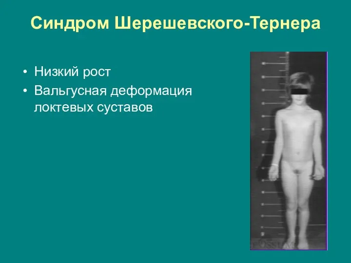 Синдром Шерешевского-Тернера Низкий рост Вальгусная деформация локтевых суставов
