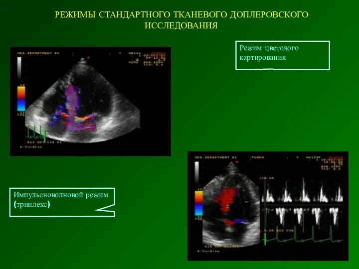 РЕЖИМЫ СТАНДАРТНОГО ТКАНЕВОГО ДОПЛЕРОВСКОГО ИССЛЕДОВАНИЯ Импульсноволновой режим (триплекс) Режим цветового картирования