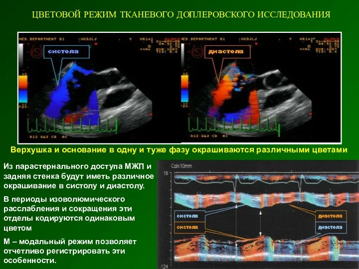 ЦВЕТОВОЙ РЕЖИМ ТКАНЕВОГО ДОПЛЕРОВСКОГО ИССЛЕДОВАНИЯ Верхушка и основание в одну
