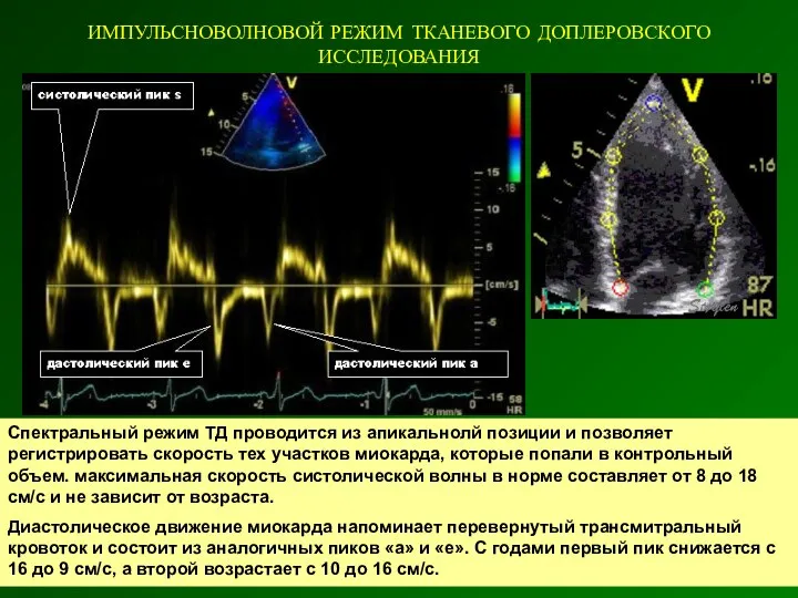 ИМПУЛЬСНОВОЛНОВОЙ РЕЖИМ ТКАНЕВОГО ДОПЛЕРОВСКОГО ИССЛЕДОВАНИЯ Спектральный режим ТД проводится из