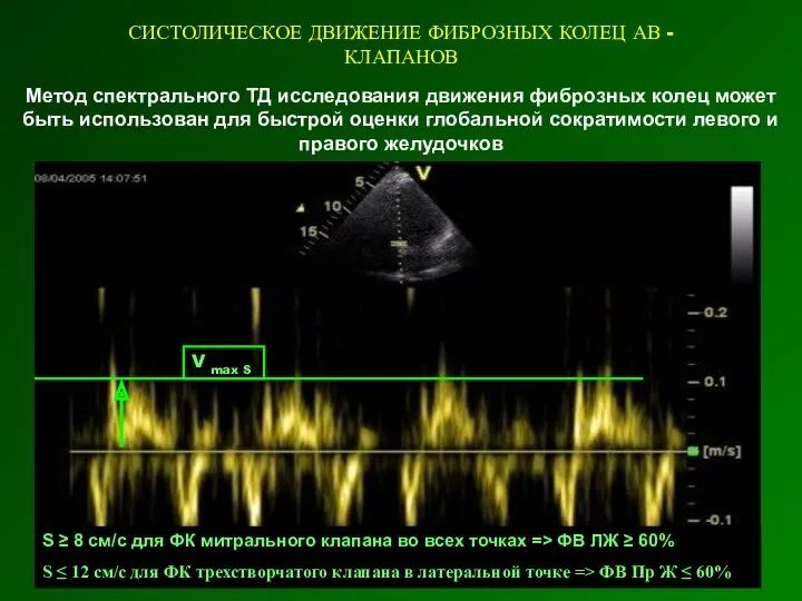 СИСТОЛИЧЕСКОЕ ДВИЖЕНИЕ ФИБРОЗНЫХ КОЛЕЦ АВ - КЛАПАНОВ Метод спектрального ТД