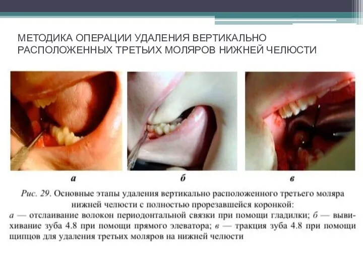 МЕТОДИКА ОПЕРАЦИИ УДАЛЕНИЯ ВЕРТИКАЛЬНО РАСПОЛОЖЕННЫХ ТРЕТЬИХ МОЛЯРОВ НИЖНЕЙ ЧЕЛЮСТИ