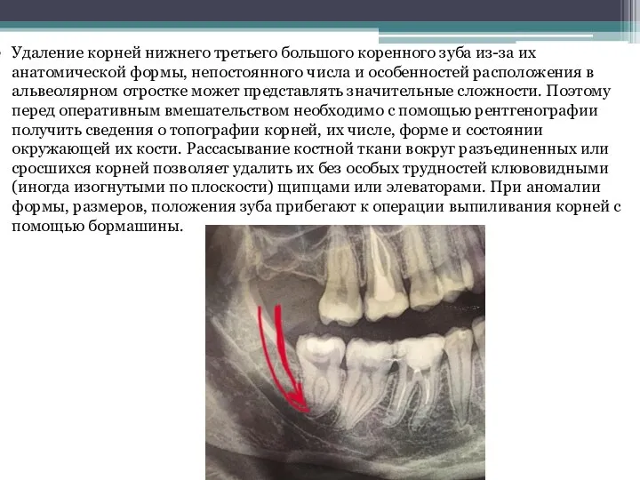 Удаление корней нижнего третьего большого коренного зуба из-за их анатомической