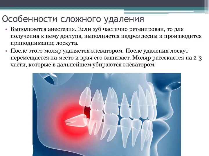 Особенности сложного удаления Выполняется анестезия. Если зуб частично ретенирован, то