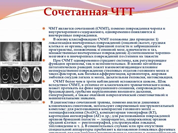 Сочетанная ЧТТ ЧМТ является сочетанной (СЧМТ), помимо повреждения черепа и