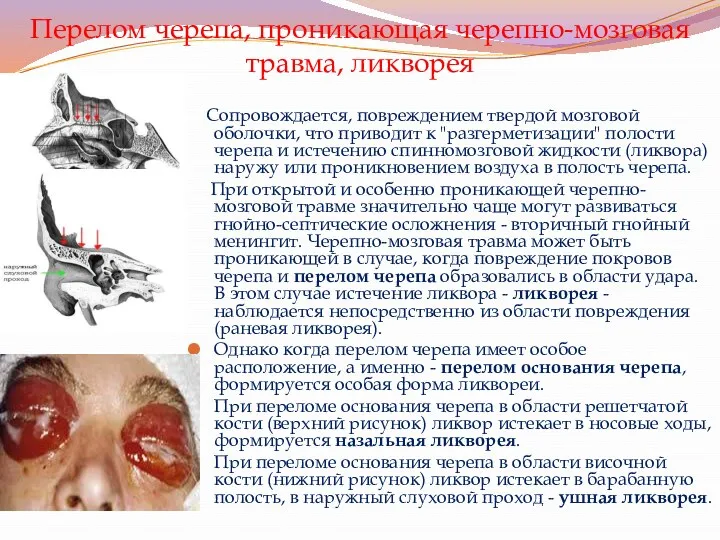 Перелом черепа, проникающая черепно-мозговая травма, ликворея Сопровождается, повреждением твердой мозговой