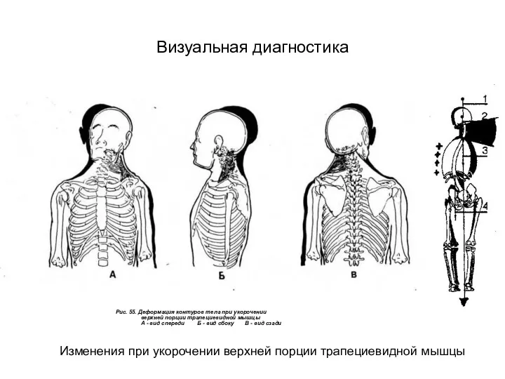 Визуальная диагностика Изменения при укорочении верхней порции трапециевидной мышцы